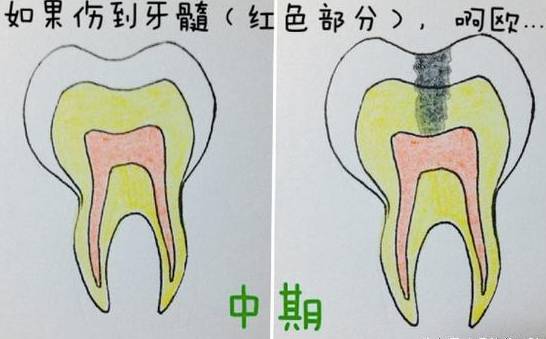 蛀牙引起的口臭怎么办