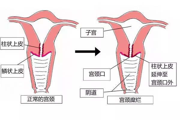柱状上皮与鳞状上皮就在宫颈口处相连