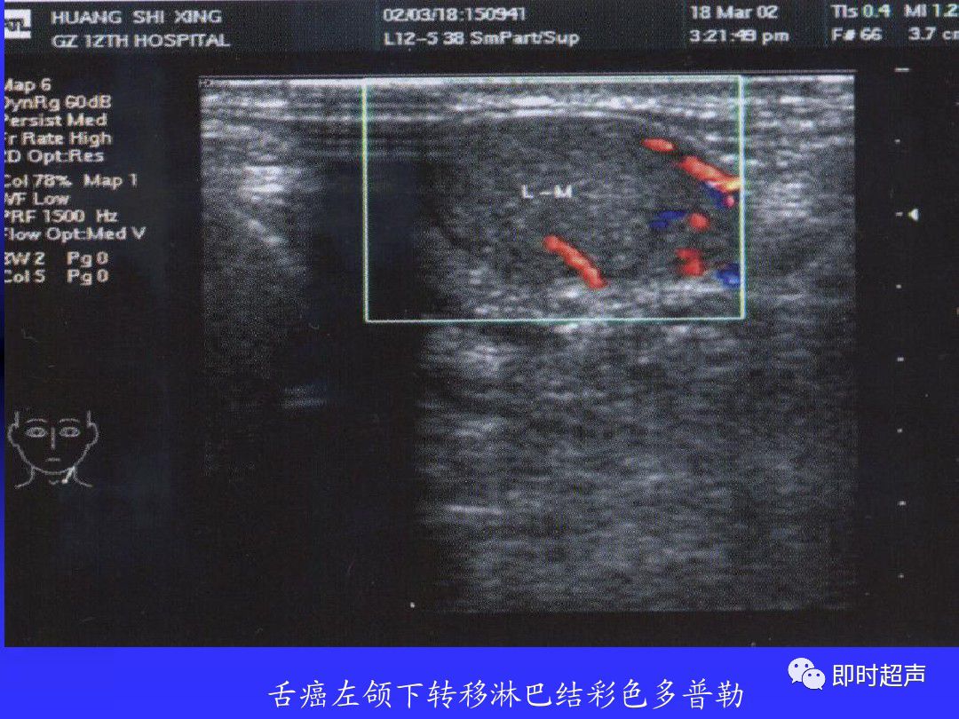 淋巴结肿大的超声诊断