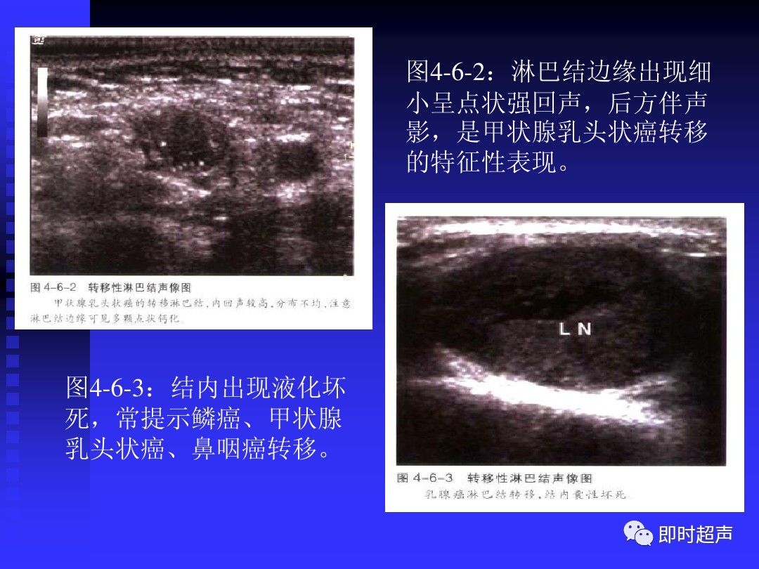 淋巴结肿大的超声诊断