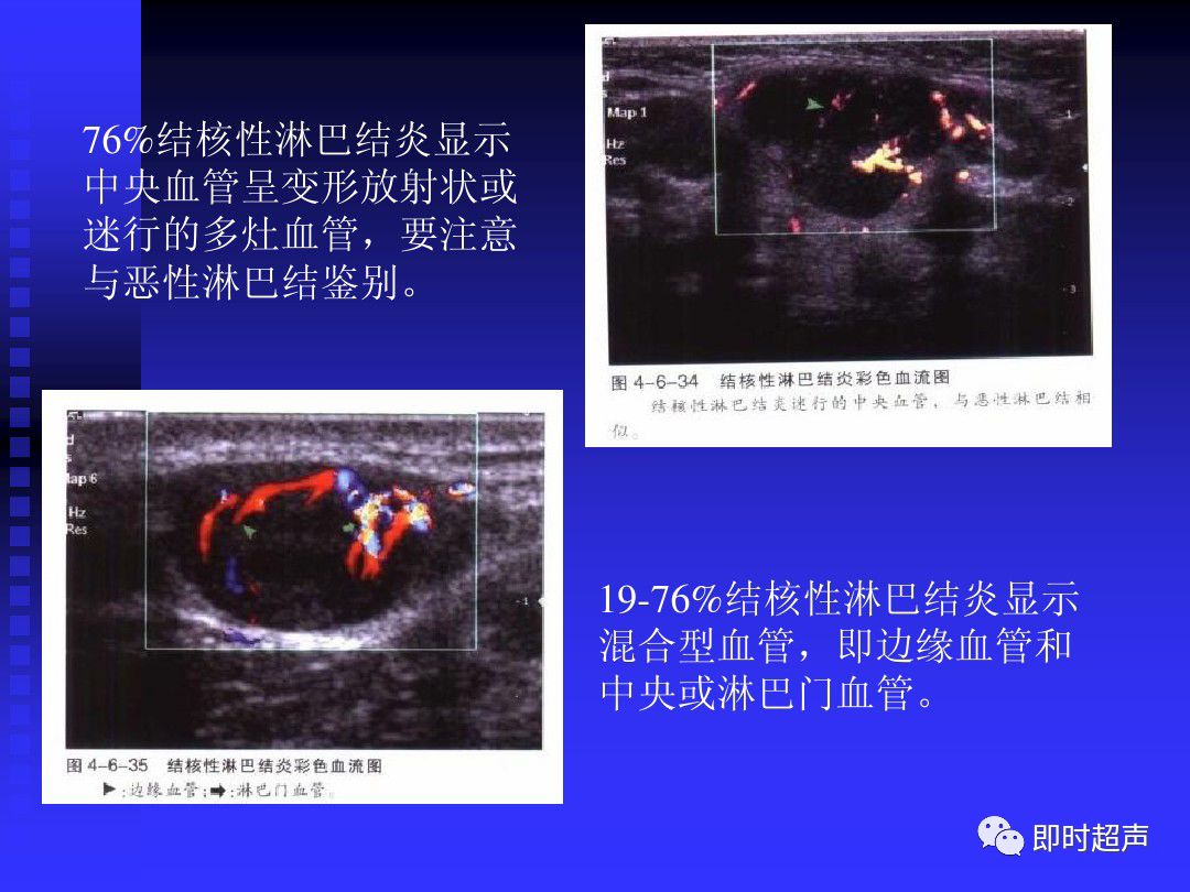 淋巴结肿大的超声诊断