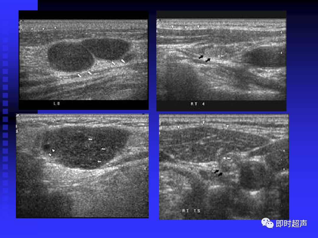 淋巴结肿大的超声诊断
