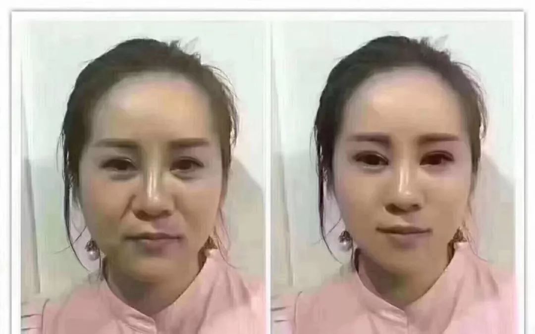 法令纹对一个女人来说. 那是极丑的,至少老了五六岁