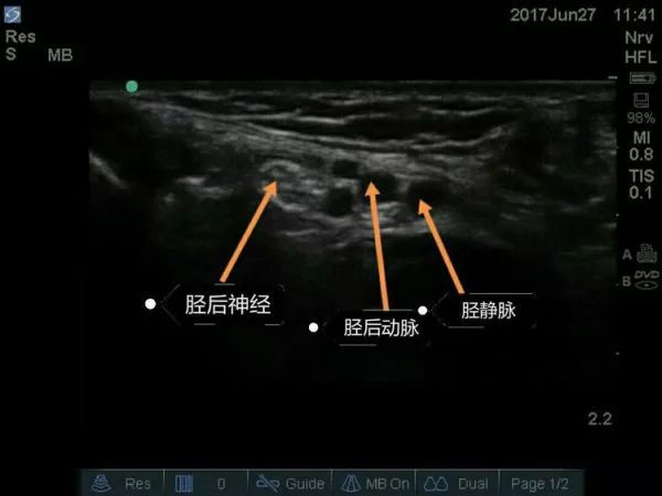 超声引导下坐骨神经阻滞要点①适应症 足与踝关节的手术.