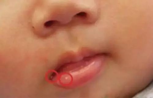 【烂嘴角】烂嘴角是怎么回事_烂嘴角的治疗方法