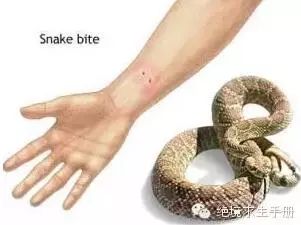 特别已确认为某种蛇咬伤或已捕获到咬伤人的蛇,应鉴别系毒蛇咬伤抑或