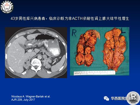 4,肾上腺皮质功能减退:各种原因引起的肾上腺皮质破坏或功能丧失.