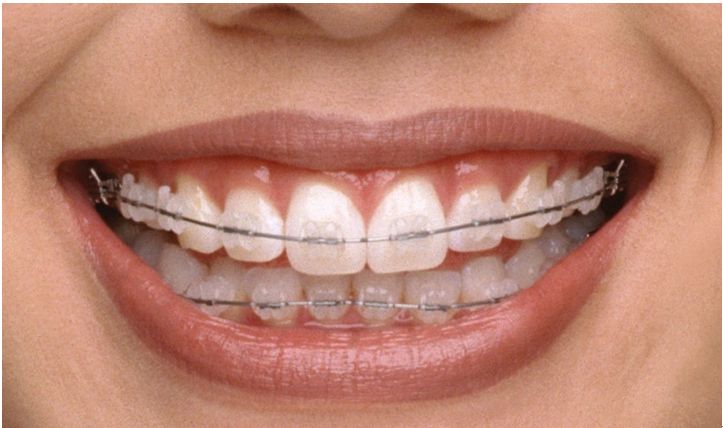 关于牙齿矫正的误区,你都中招了?