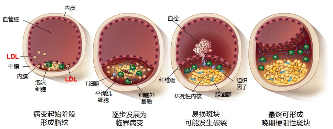 的始动环节:富含胆固醇的ldl进入血管壁内[3] 动脉粥样硬化斑块的发生