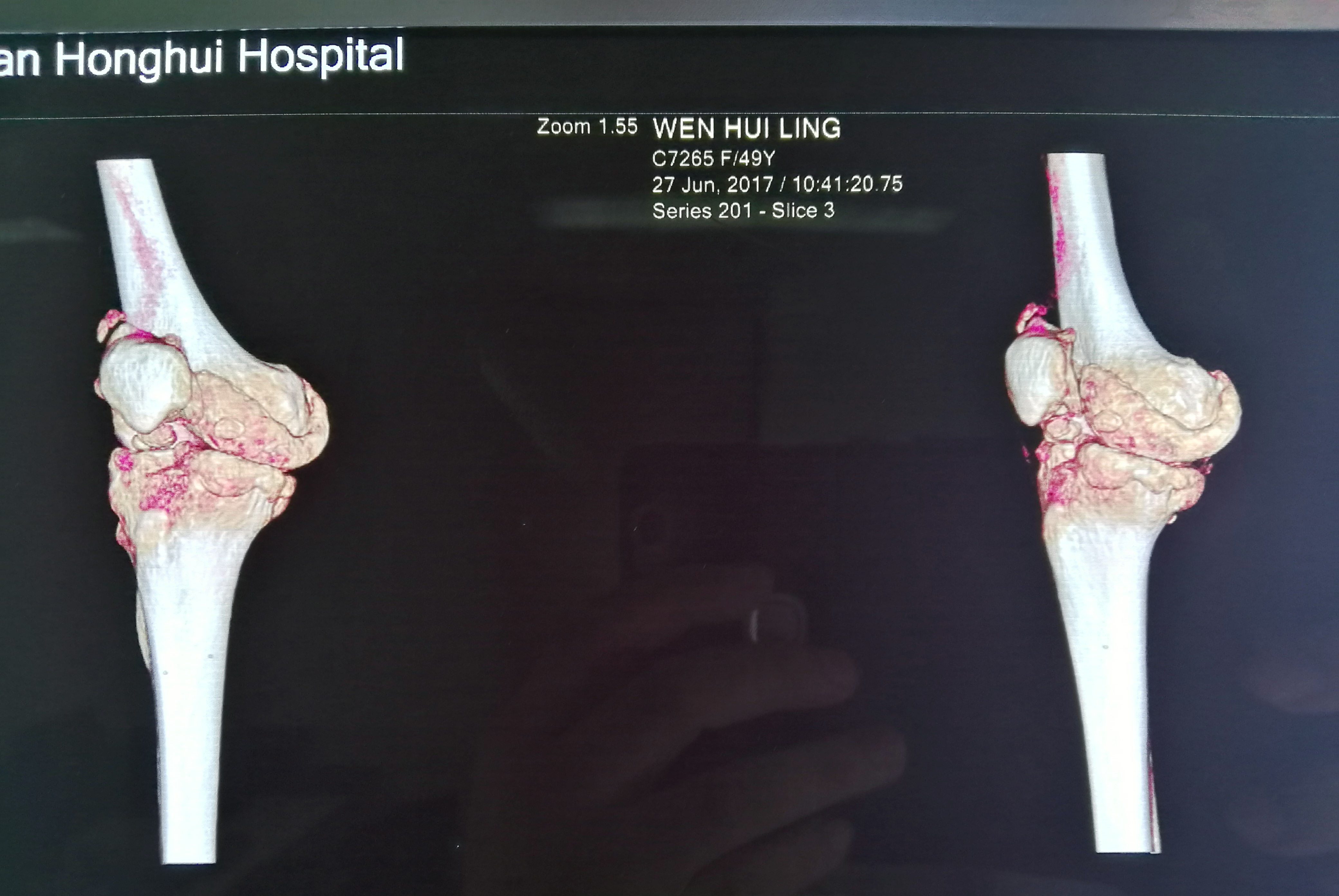 【典型病例-类风湿性关节炎】"顺风膝"双侧膝关节置换