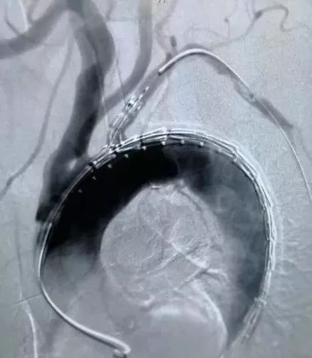 病例分享castor03分支型主动脉覆膜支架系统治疗主动脉弓部多发溃疡