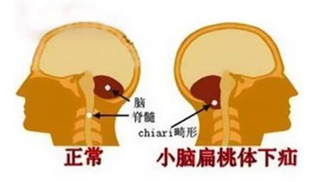 刘教授诊断为小脑扁桃体下疝畸形,脊髓空洞症