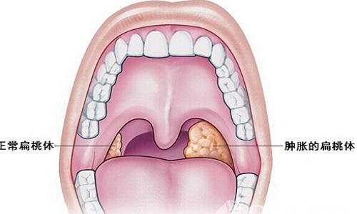 注意口腔卫生,避免食物残渣留存在口腔中与细菌混杂,诱发/加重扁桃体