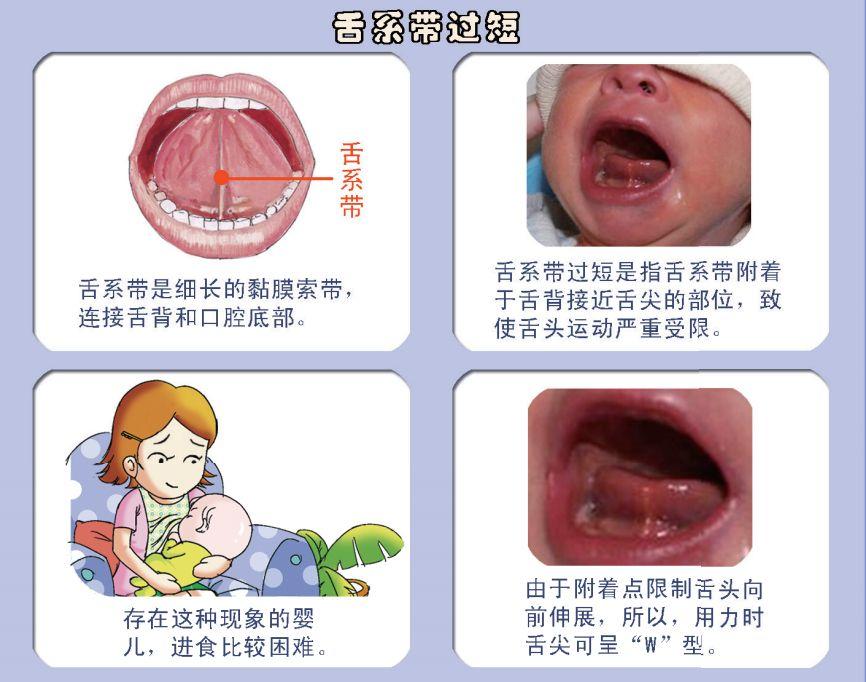 舌系带短的孩子 为什么也能正常说话