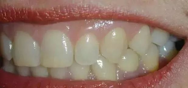 健康的牙龈颜色是sweet的 粉红色,边缘应该贴合牙面,质地坚韧而富有
