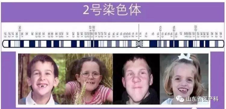 智力低下,寿命可至成年 angelman syndrome 1/40000 面孔似"快乐木偶"