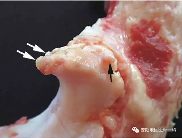 什么是骨刺长骨刺了怎么办