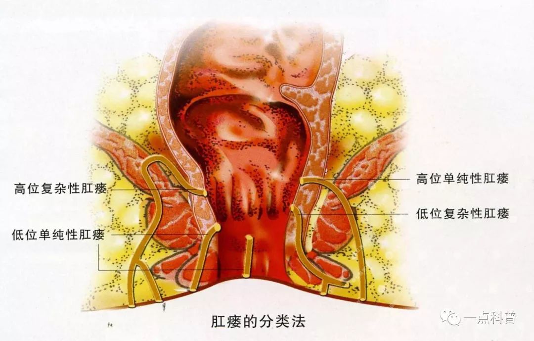 在会阴部位的是肛瘘的外口,瘘管在会阴和肛门直肠的周围组织,内口开在