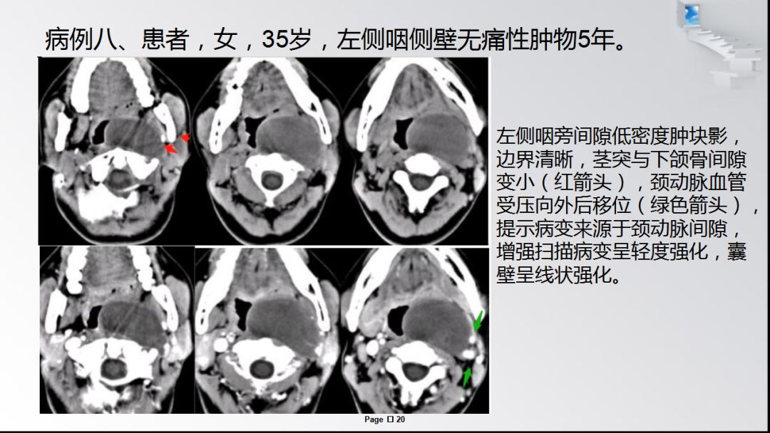 咽旁间隙常见肿瘤病变诊断超全整理