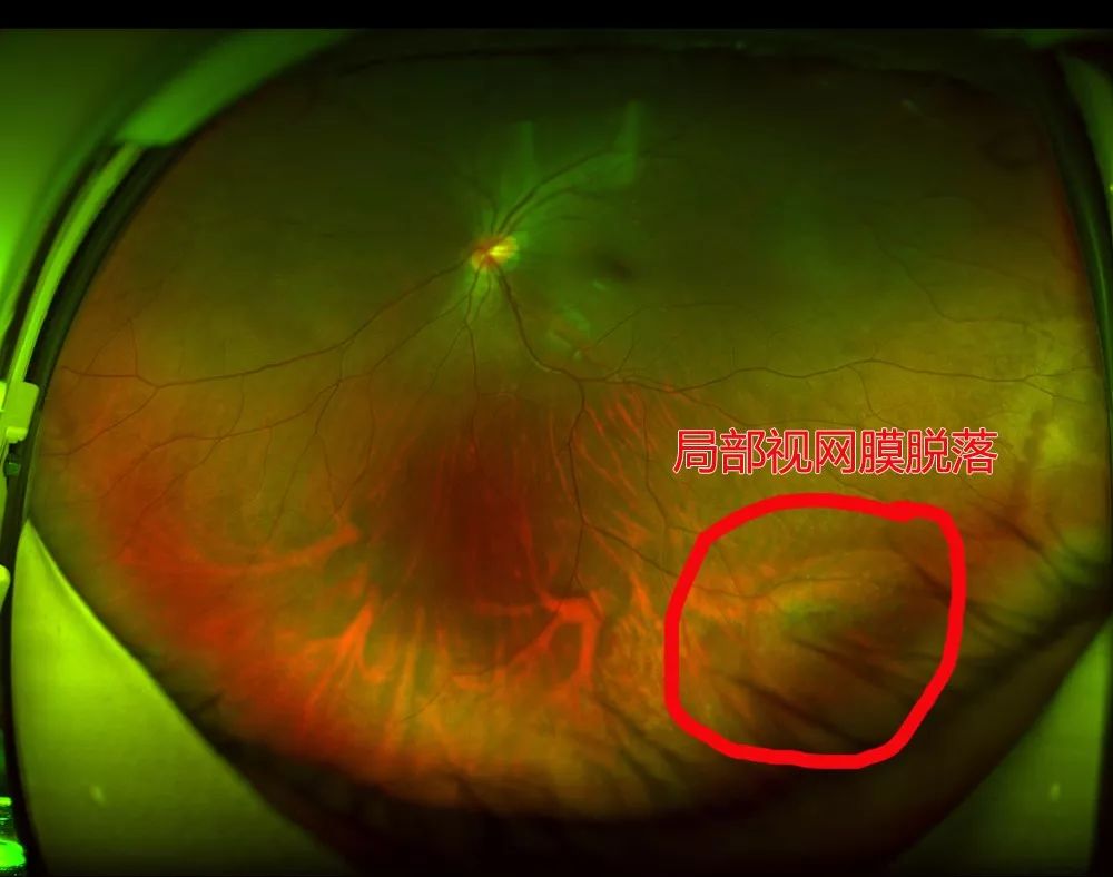 (我院员工日前例行眼健康检查的时候,就有近10人发现眼底视网膜有裂孔