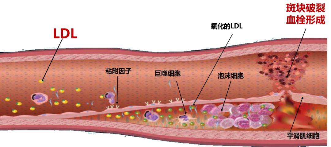 刘煜德:稳定&逆转斑块,舍"他"其谁?