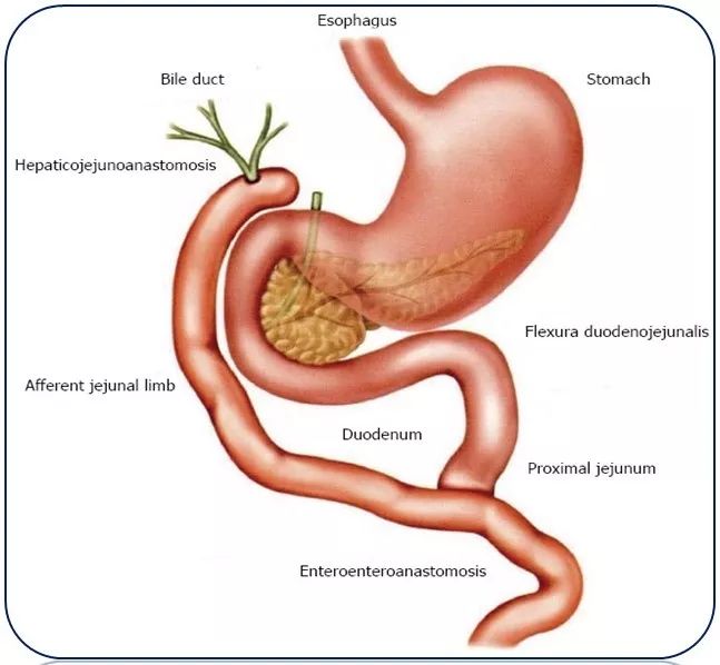 roux-en-y吻合术