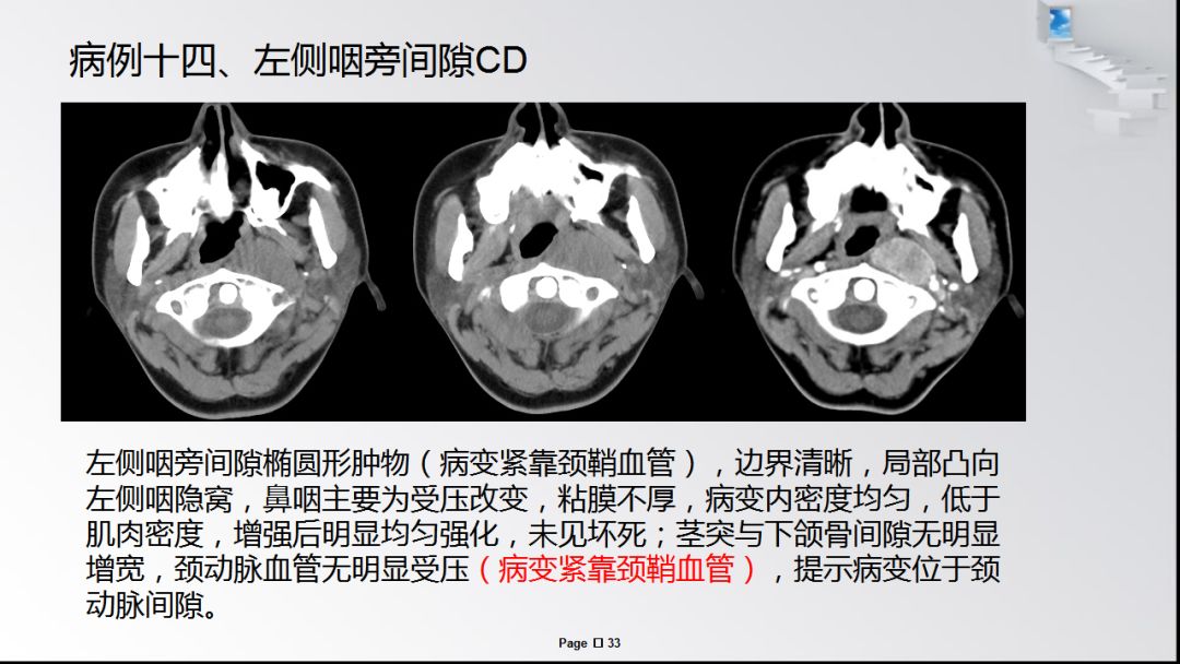 咽旁间隙常见肿瘤病变诊断超全整理