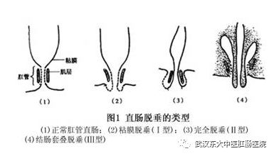 【疾病与预防】总便秘腹泻,警惕直肠脱垂!