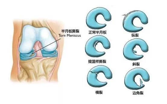 半月板损伤还能自愈?老宗堂为你分析