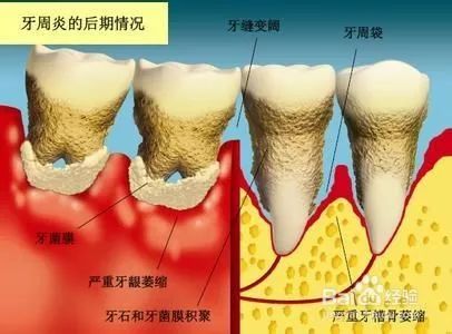 查看下面的图片 牙龈炎阶段:牙龈红肿出血,牙齿周围有牙石 牙周疾病在