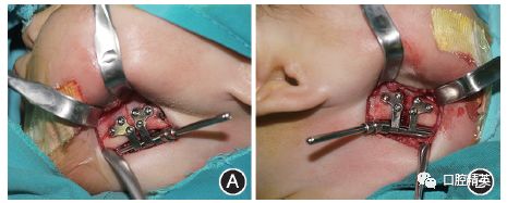 图3 下颌骨双侧截骨术 牵引器植入术手术过程,显示下颌骨双侧截骨后
