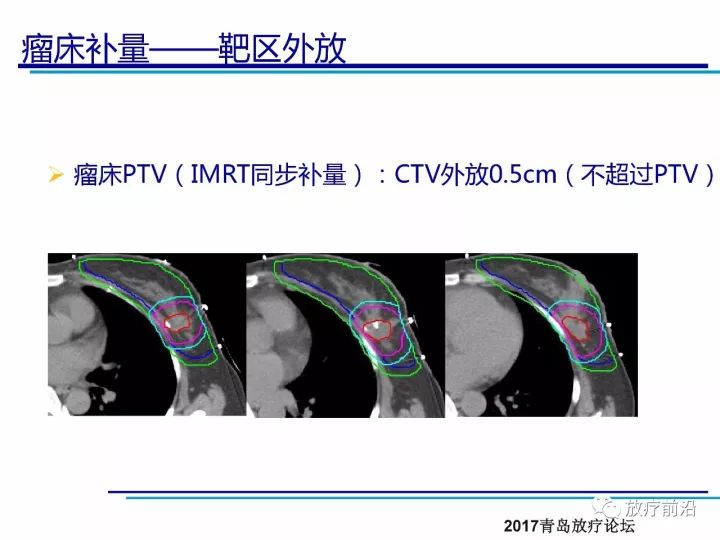 课件| 王淑莲:乳腺癌保乳术后放疗靶区勾画