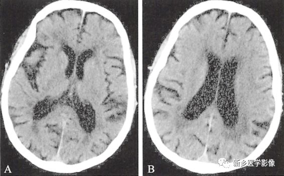 两种常见脑萎缩ct表现