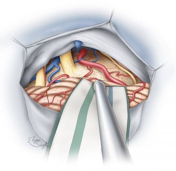 切除肿瘤后可见后颅窝的解剖,如图显示了乙状窦后和小脑上入路的手术