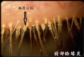 话说烂眼边