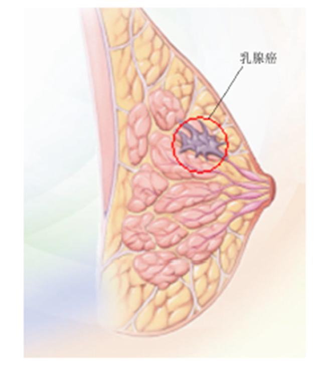 96岁老人患上乳腺癌肿块疯长5个月比拳头大