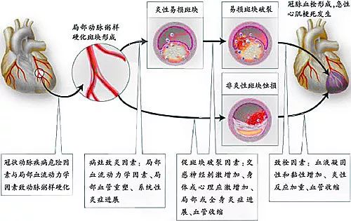 冠心病与牵涉痛