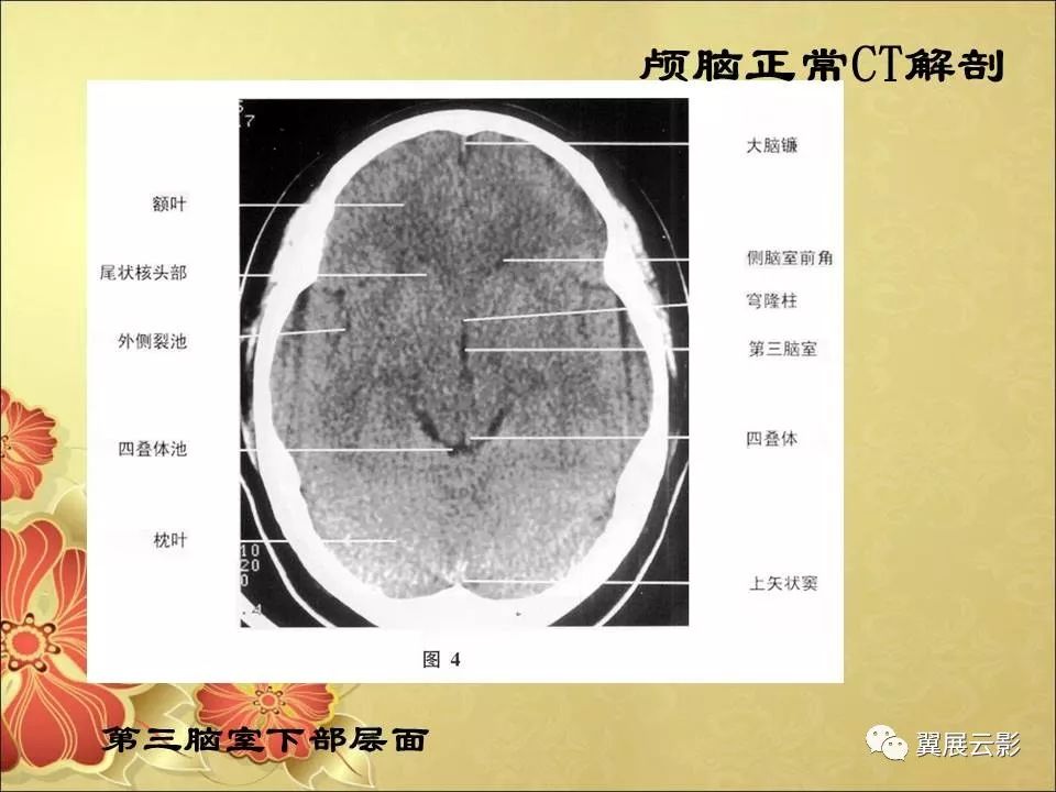 头部ct解剖及常见疾病的影像诊断