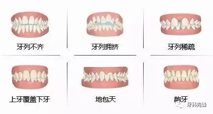 孩子错颌(地包天)怎么办