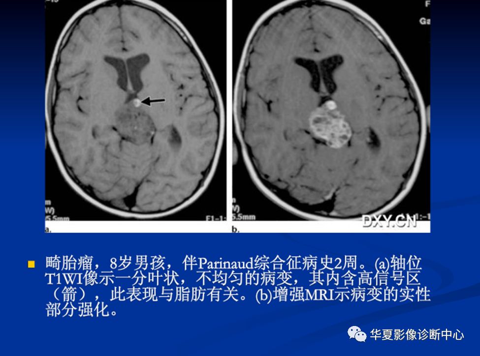 松果体瘤的影像表现与签别诊断