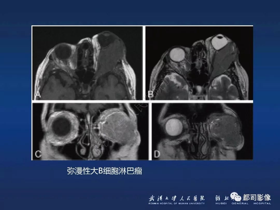 眼眶黏膜相关淋巴组织淋巴瘤影像诊断