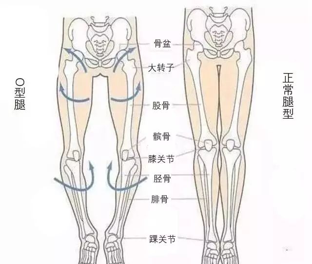 o型腿一般指的是罗圈腿,医学上又称为"膝内翻".