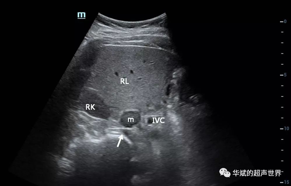 超声基础解剖:右侧肾上腺的扫查