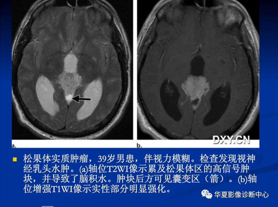 松果体瘤的影像表现与签别诊断