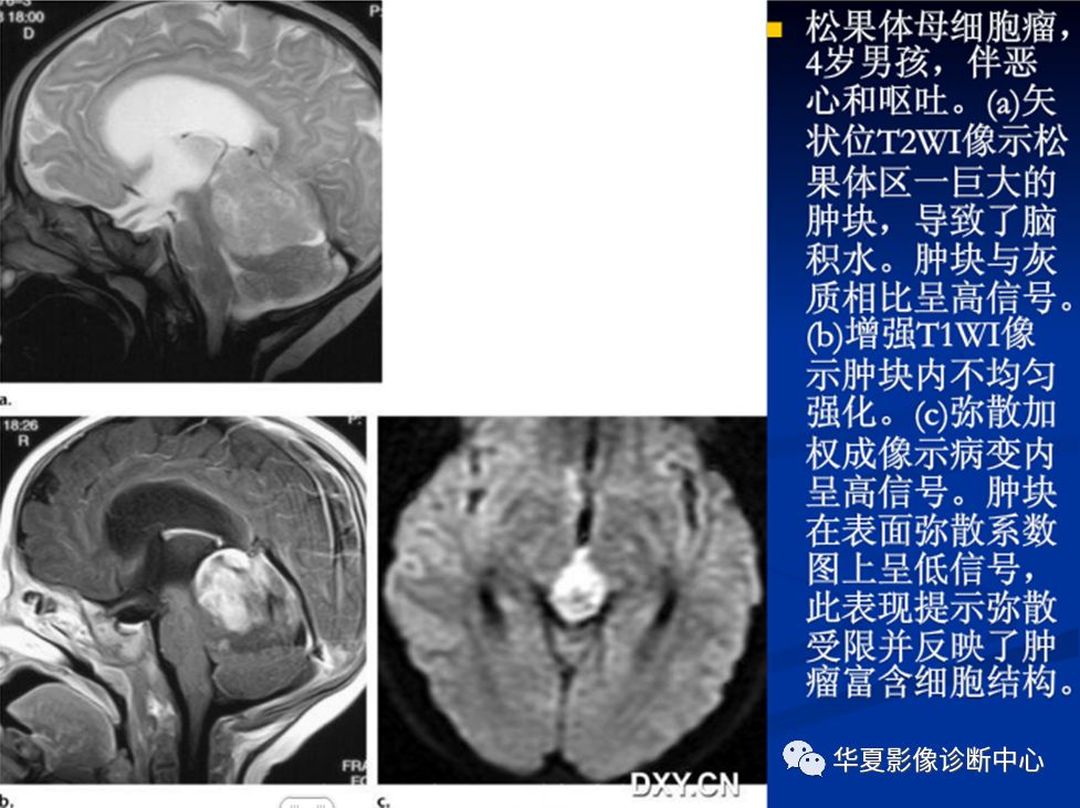 松果体瘤的影像表现与签别诊断