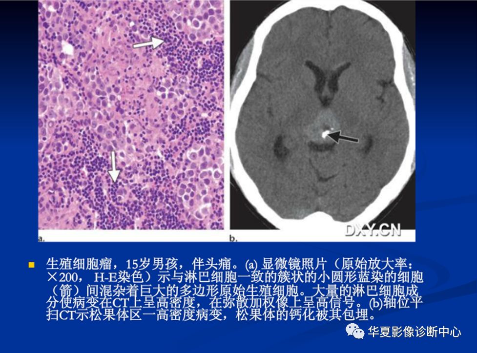 松果体瘤的影像表现与签别诊断