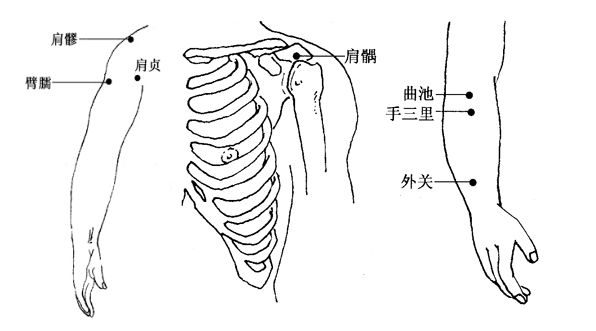 (1)选穴肩髃,肩髎,阿是穴,阳陵泉.