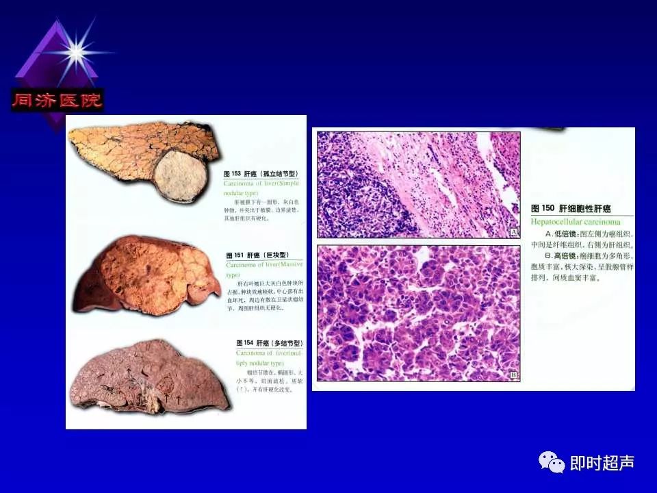 正常肝脏的超声解剖及局限病变的超声诊断