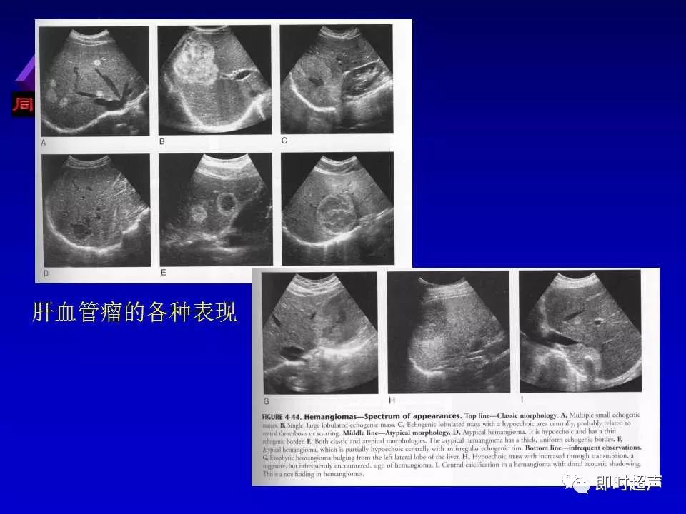 正常肝脏的超声解剖及局限病变的超声诊断