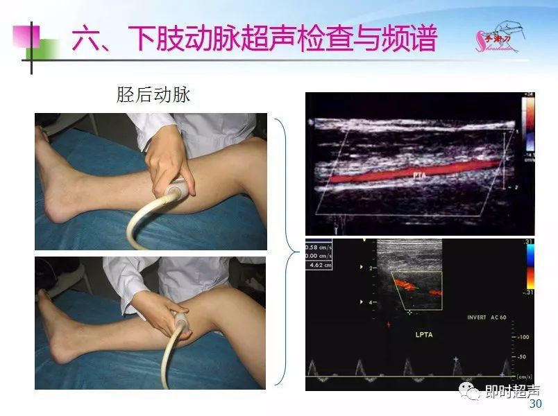 下肢血管的超声检查及正常声像图